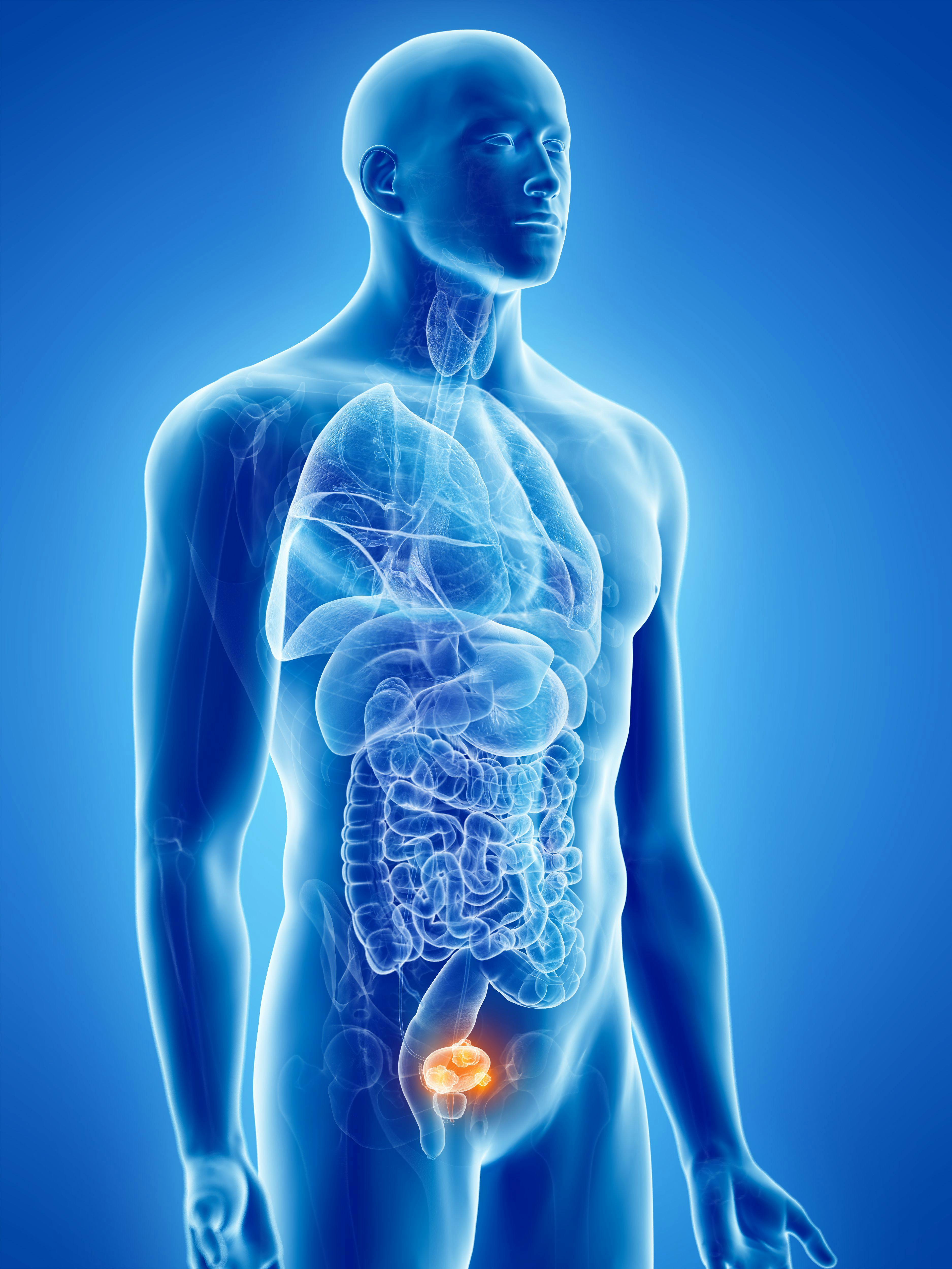3D anatomical illustration of bladder cancer: © SciePro - stock.adobe.com