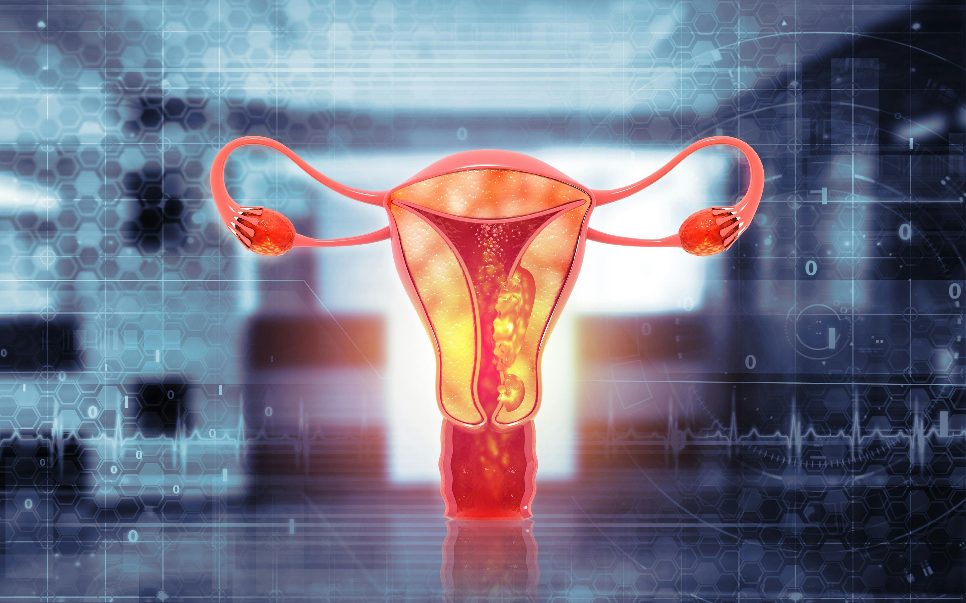 Uterus cancer and endometrial malignant tumor as a uterine medical concept illustration: © Crystal Light - stock.adobe.com