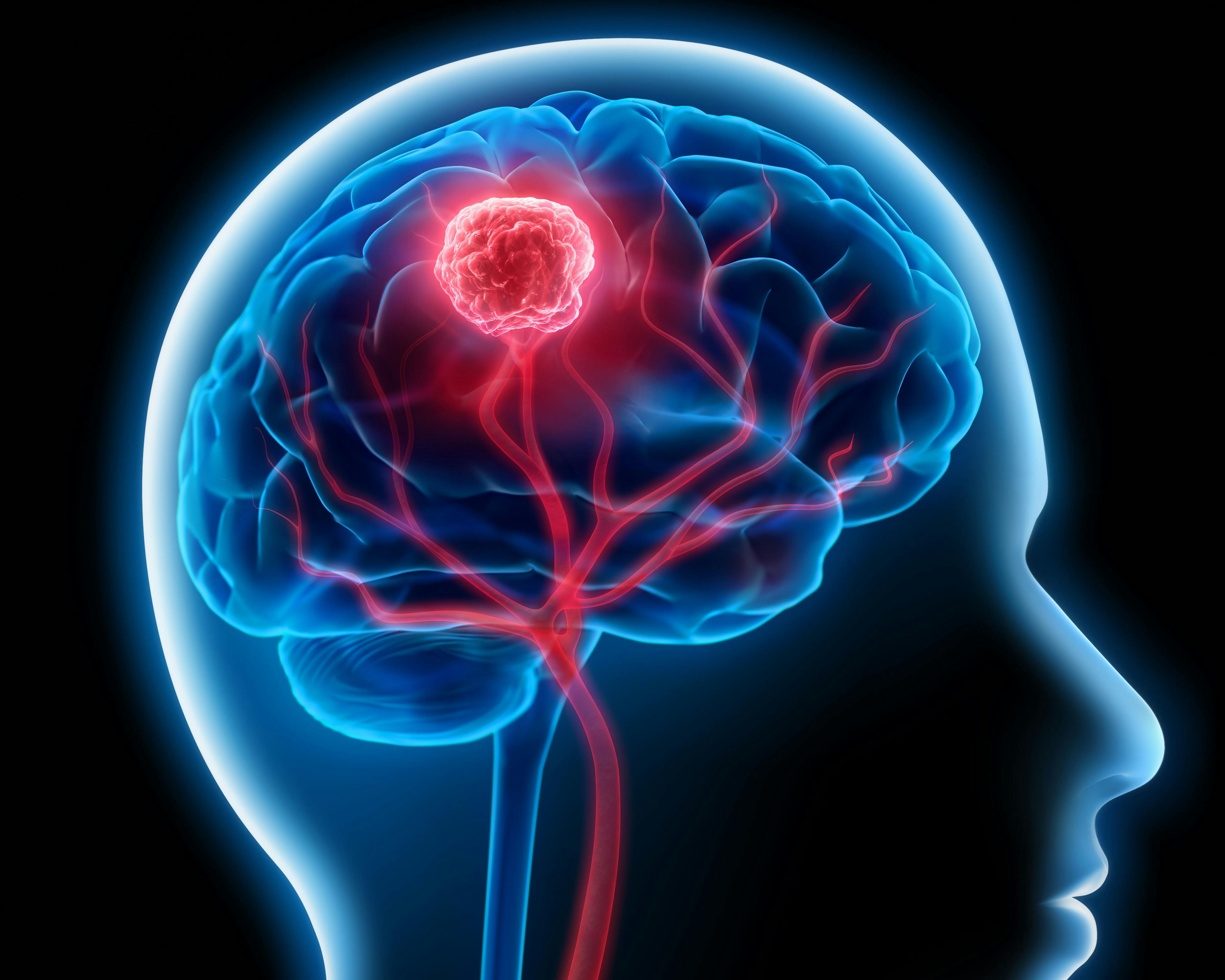 3D illustration of tumor in brain: © peterschreiber.media - stock.adobe.com