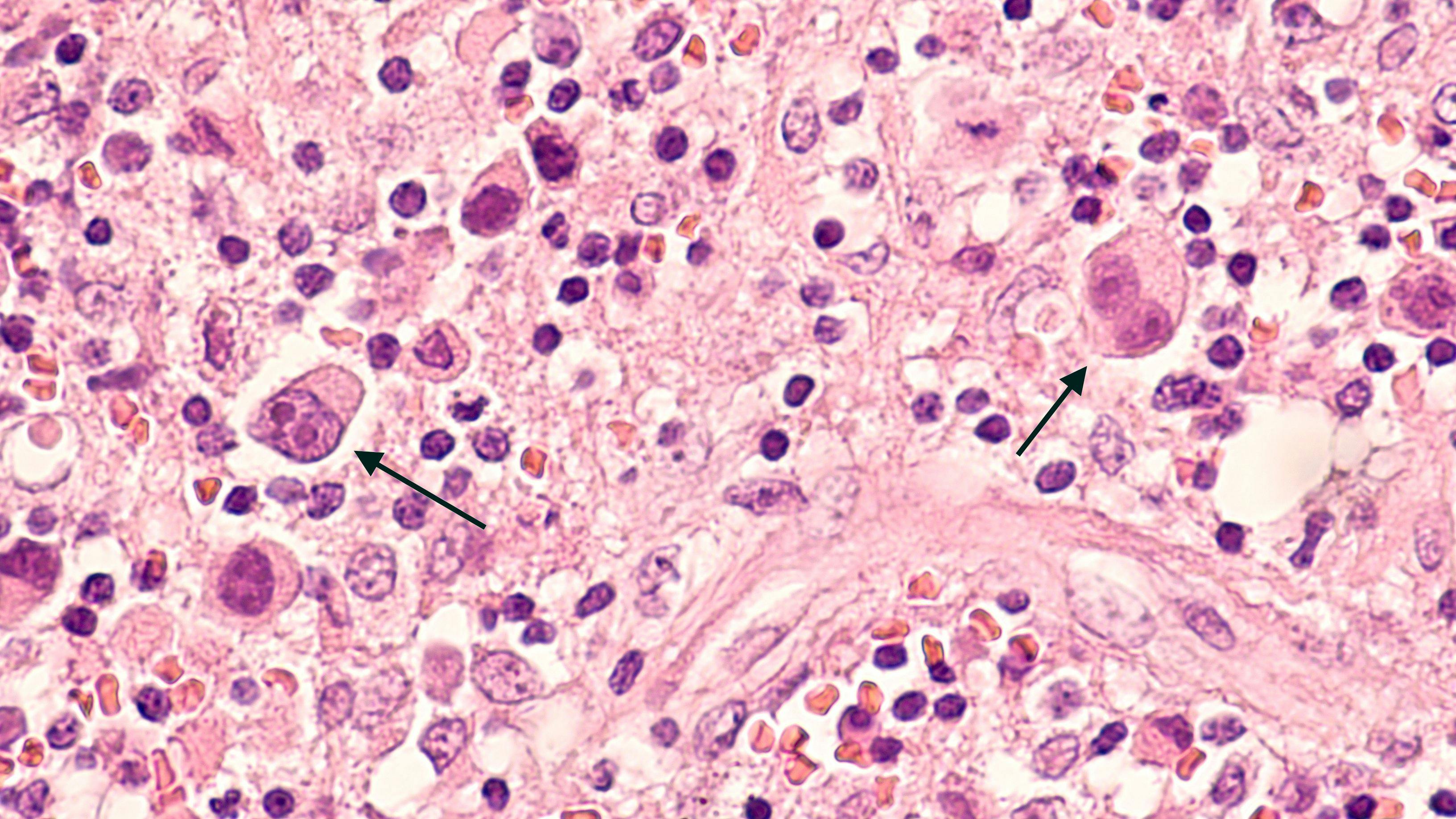 Image of lymphoma cells: © David A Litman - www.stock.adobe.com.jpg