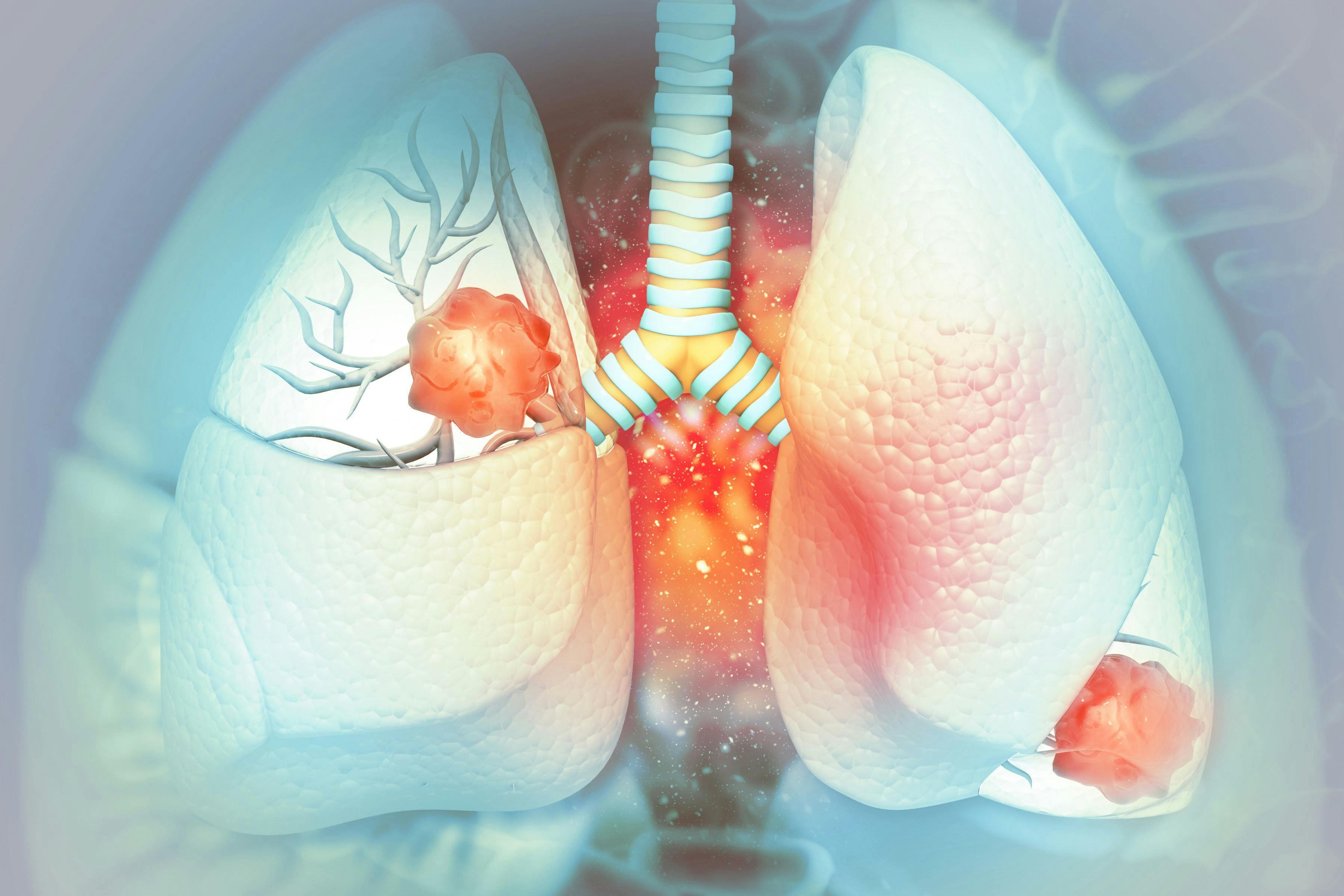 Lung Cancer: ©Crystal Light - stock.adobe.com