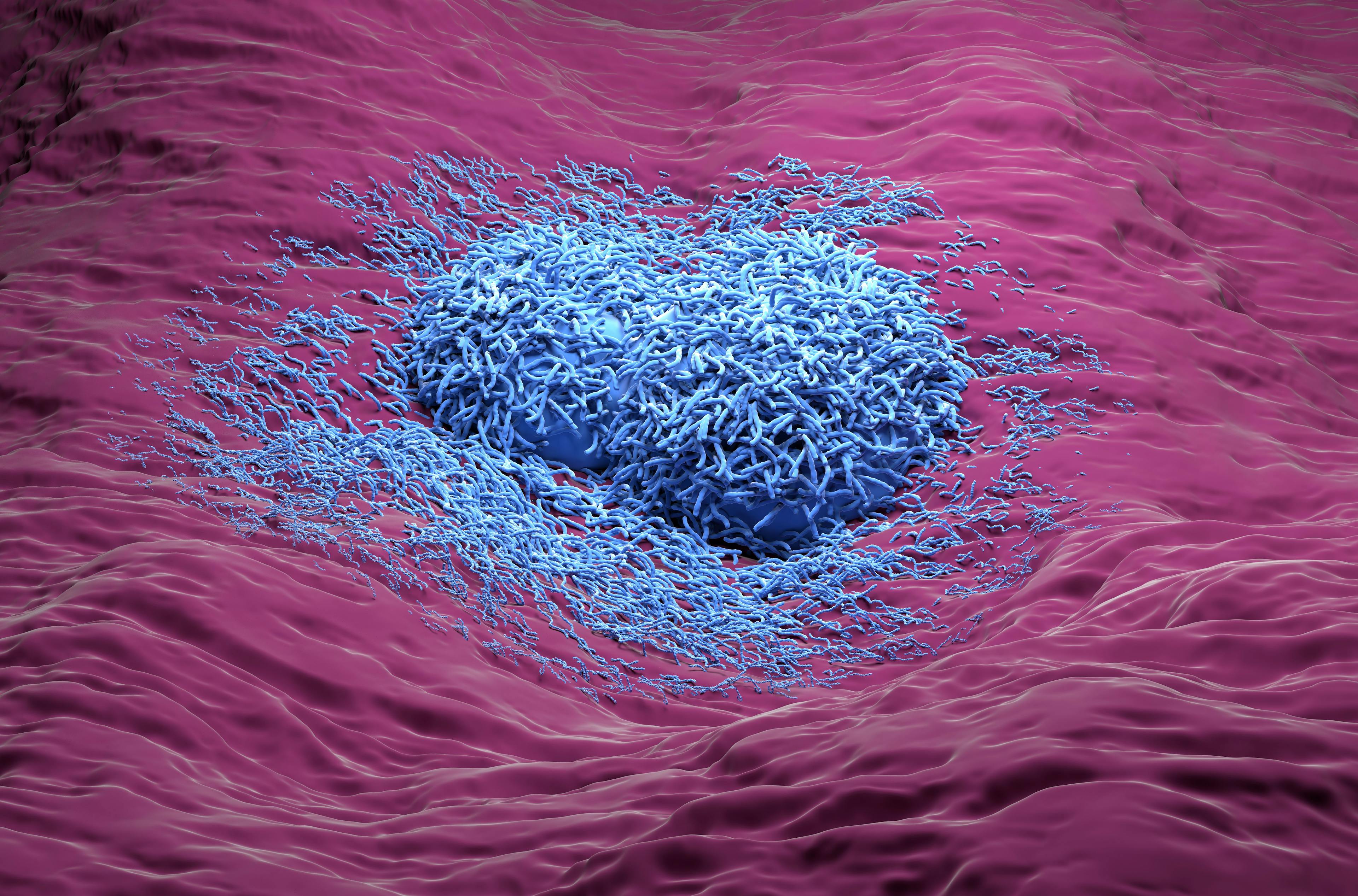 Liver cancer hepatoma blue color realistic side view 3d illustration | Image Credit: © LASZLO - www.stock.adobe.com 