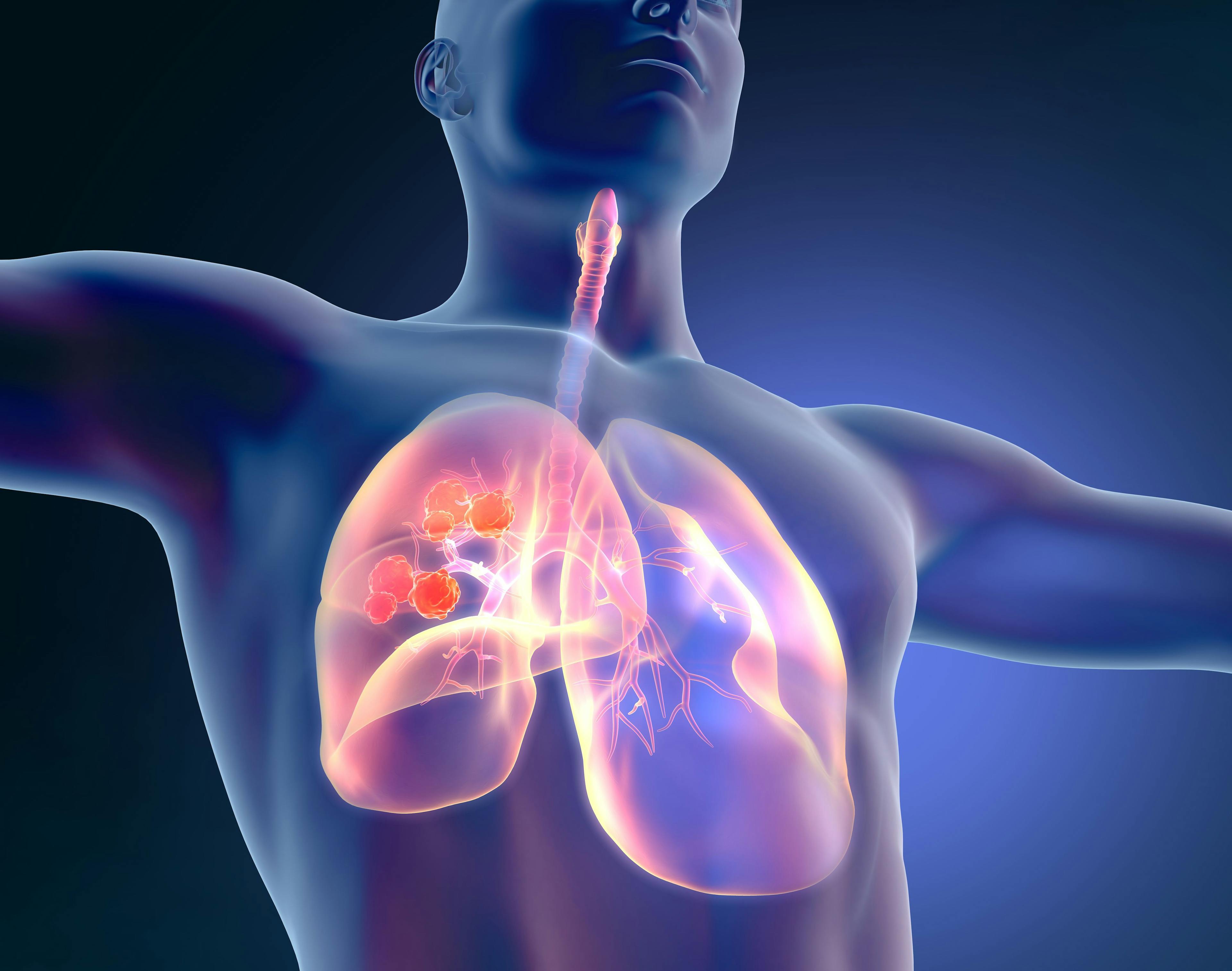 Lung cancer, medical illustration | Image Credit: © Axel Kock - www.stock.adobe.com