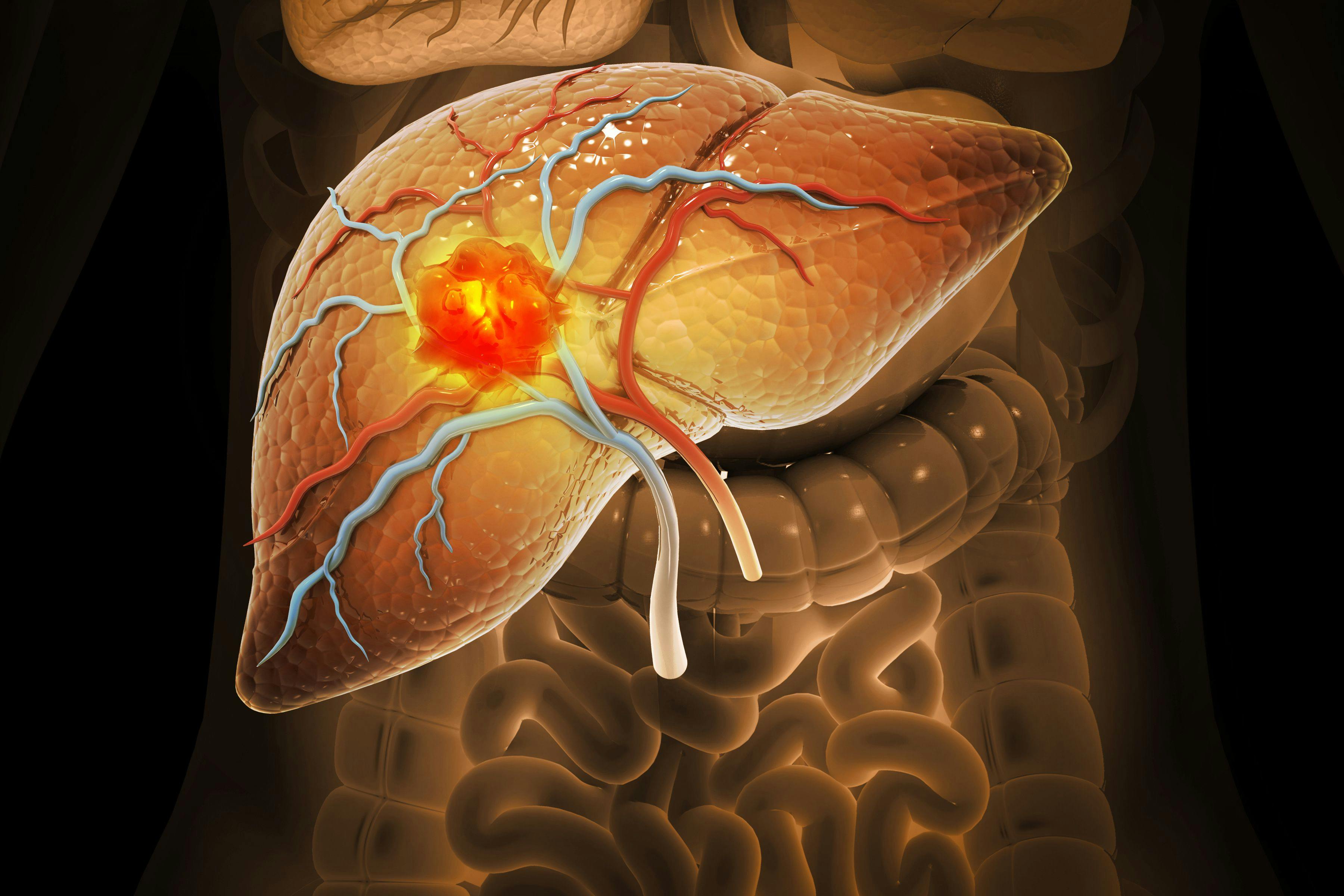 Liver cancer, Hepatocellular Carcinoma (HCC), conditions, causes and treatment. 3d illustration : © Crystal light - stock.adobe.com