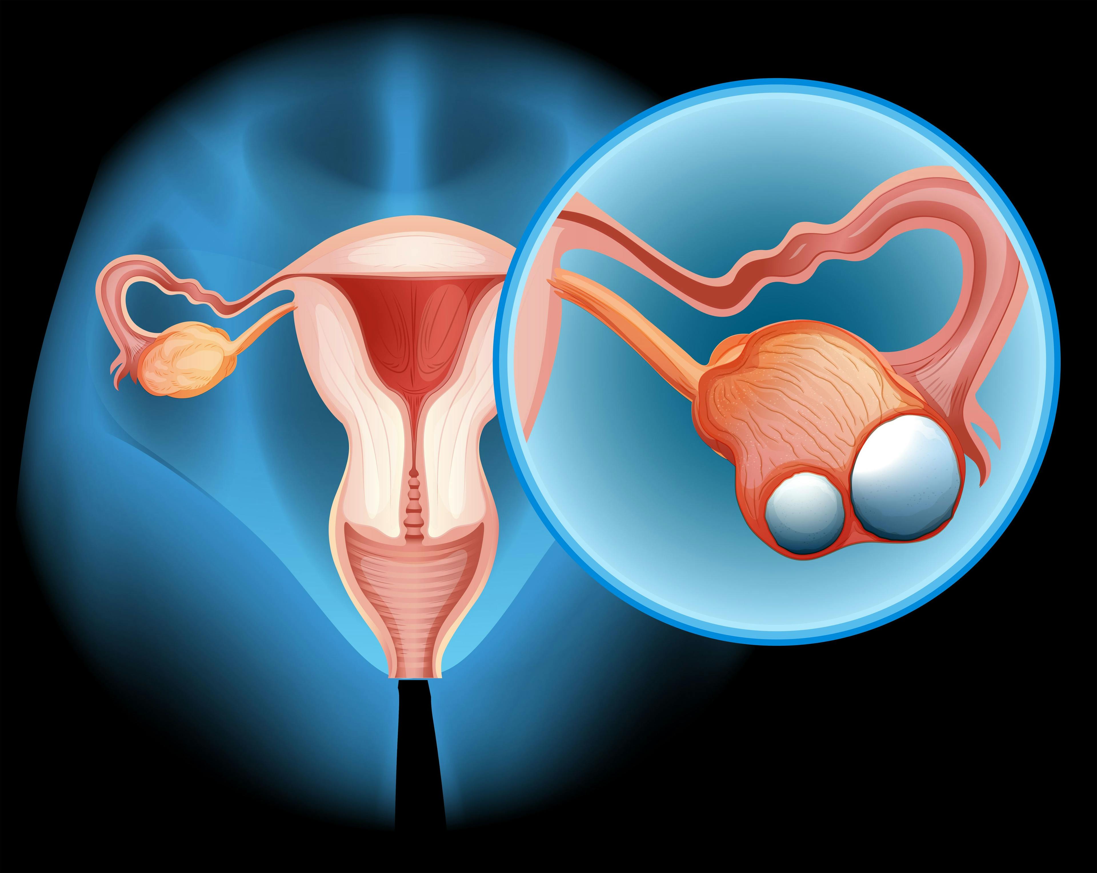 Illustration of ovarian cancer - stock.adobe.com