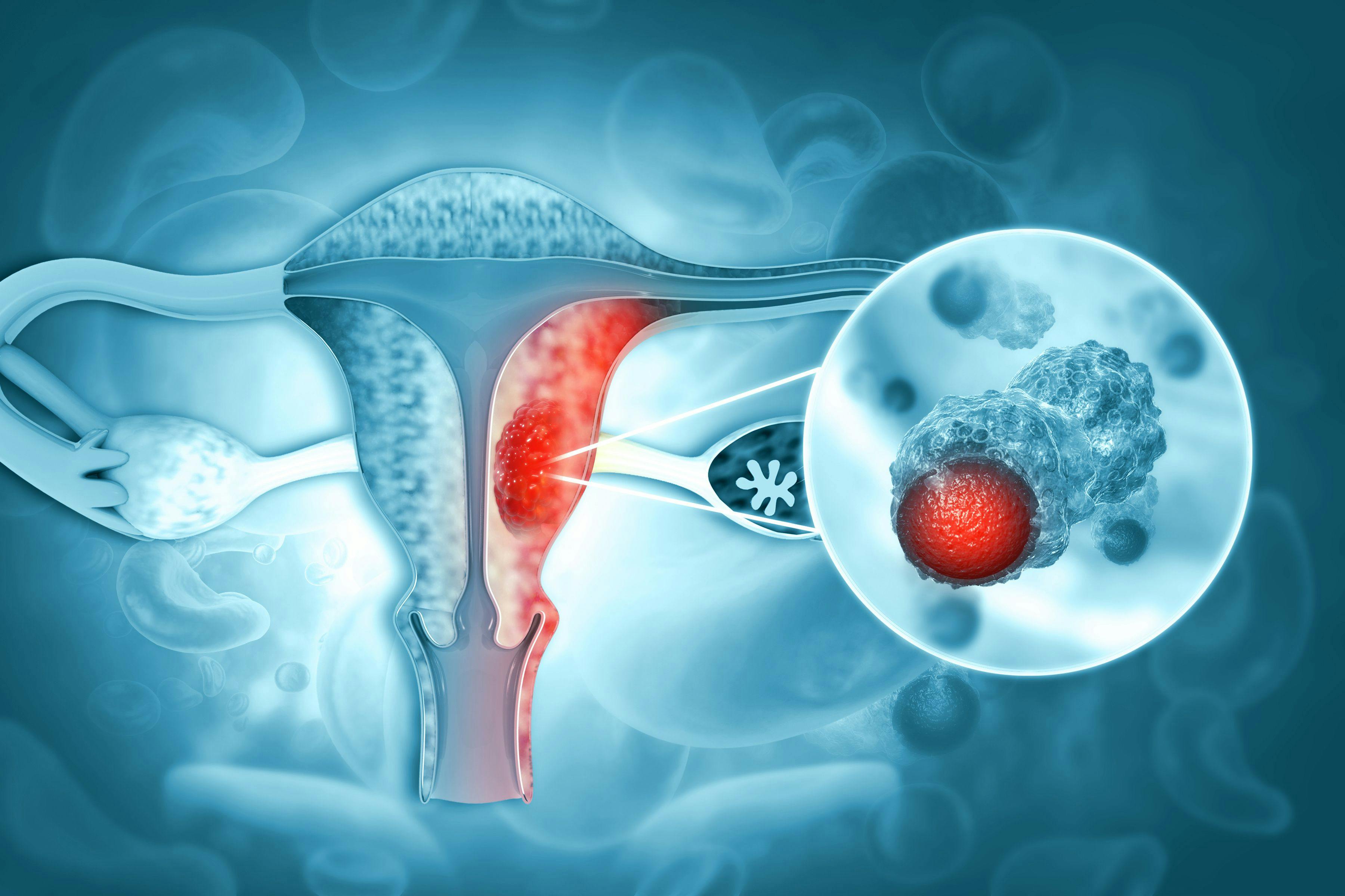 Female reproductive system diseases. Uterus cancer and endometrial malignant tumor as a uterine medical: ©Crystal Light - stock.adobe.com