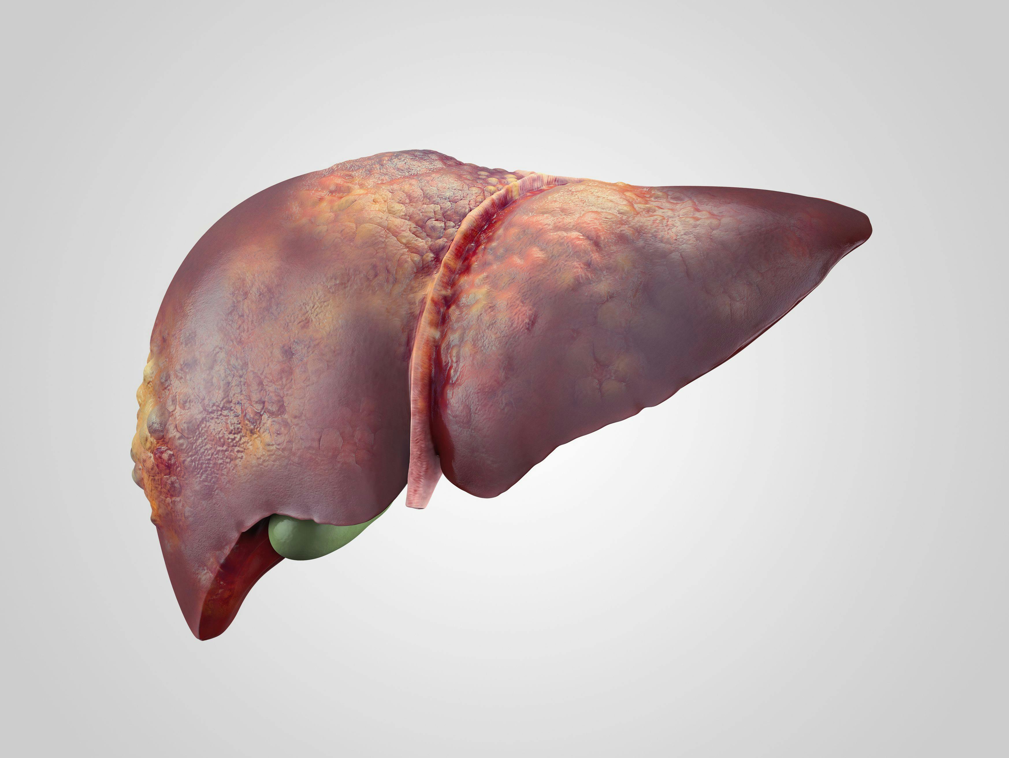 liver cancer HCC