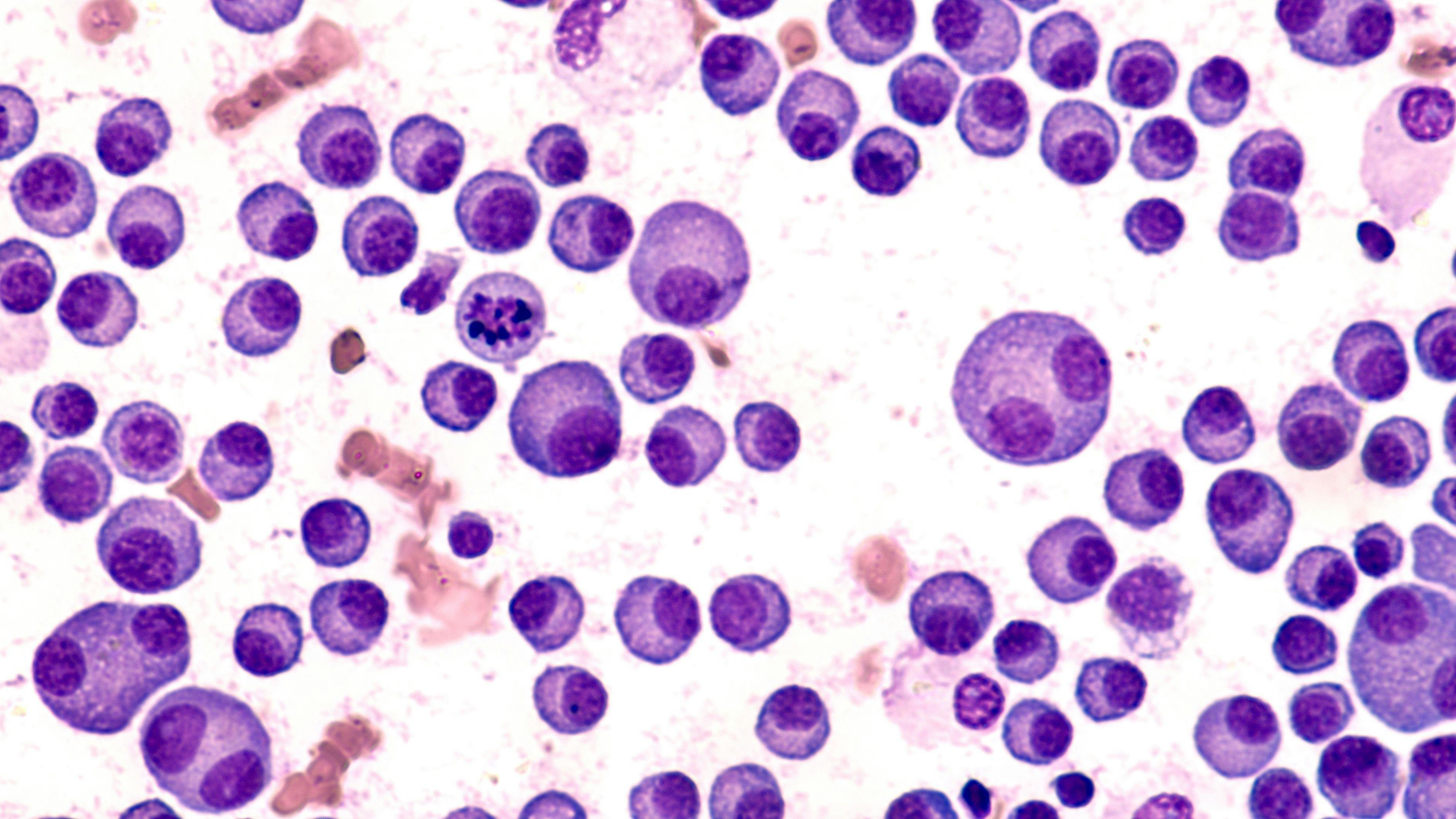 Bone marrow aspirate cytology of multiple myeloma: ©David A Litman - stock.adobe.com