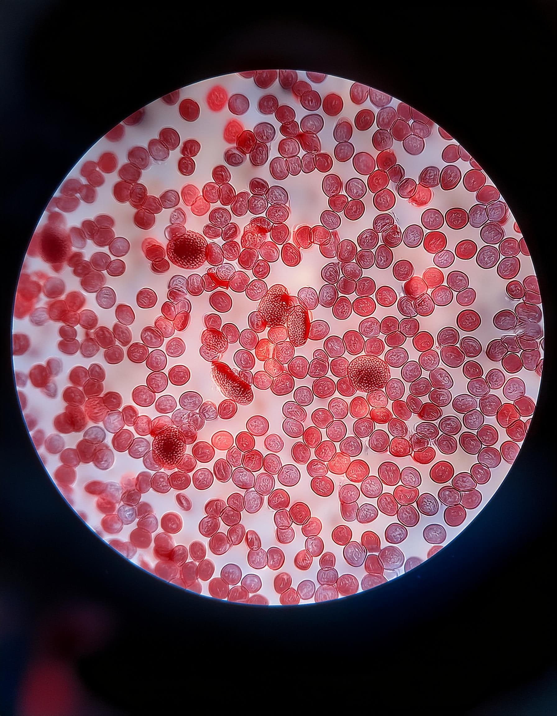 Microscopic, photorealistic image of leukemia cells - Generated with Adobe Firefly