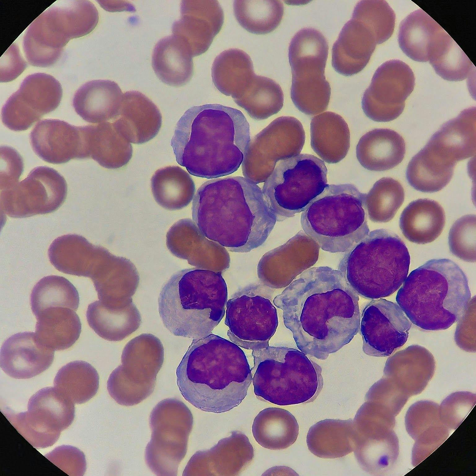 Microscopic image of CLL cells - Generated with Google Gemini AI