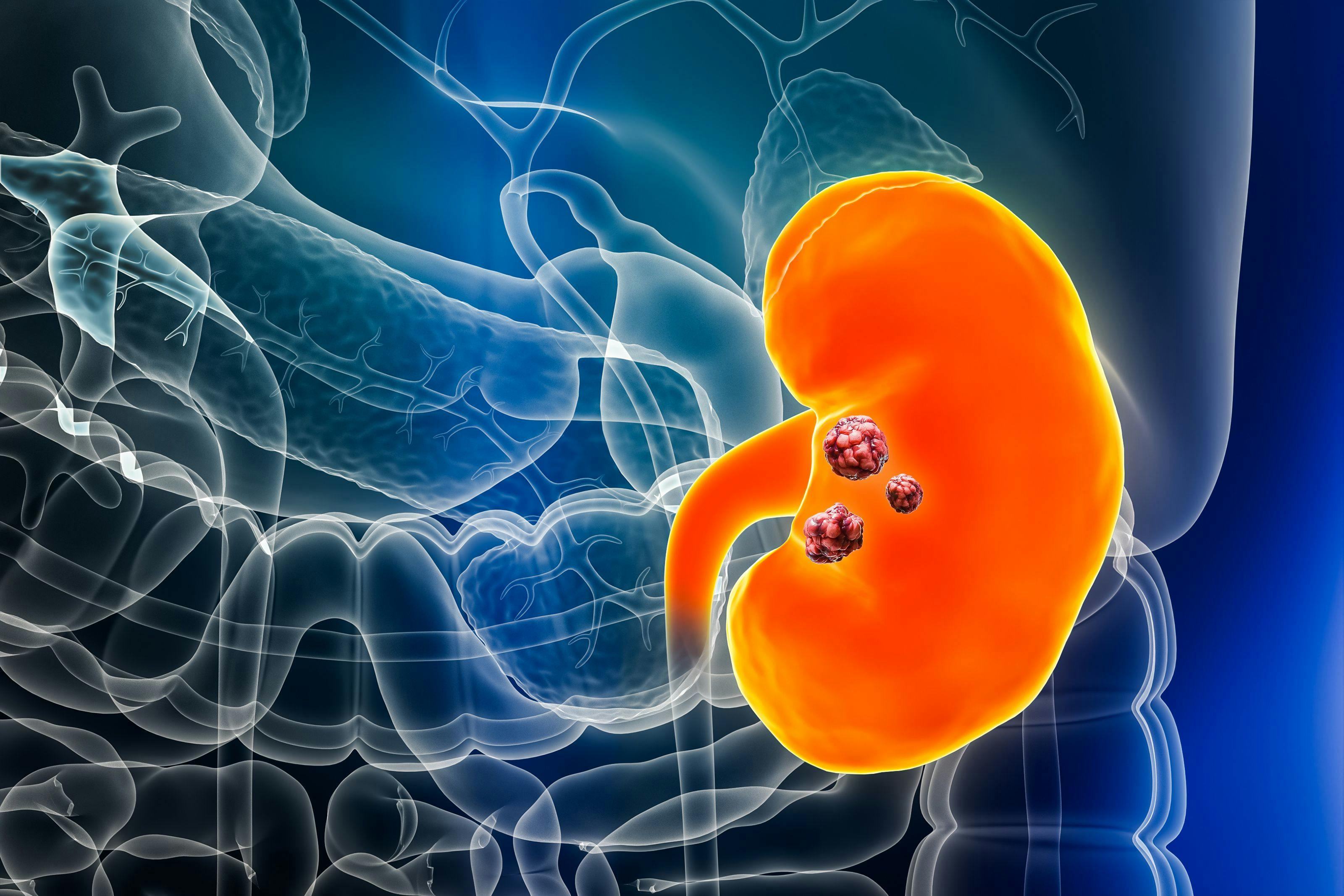 3D rendering of kidney cancer with organs and tumors: © Matthieu - stock.adobe.com