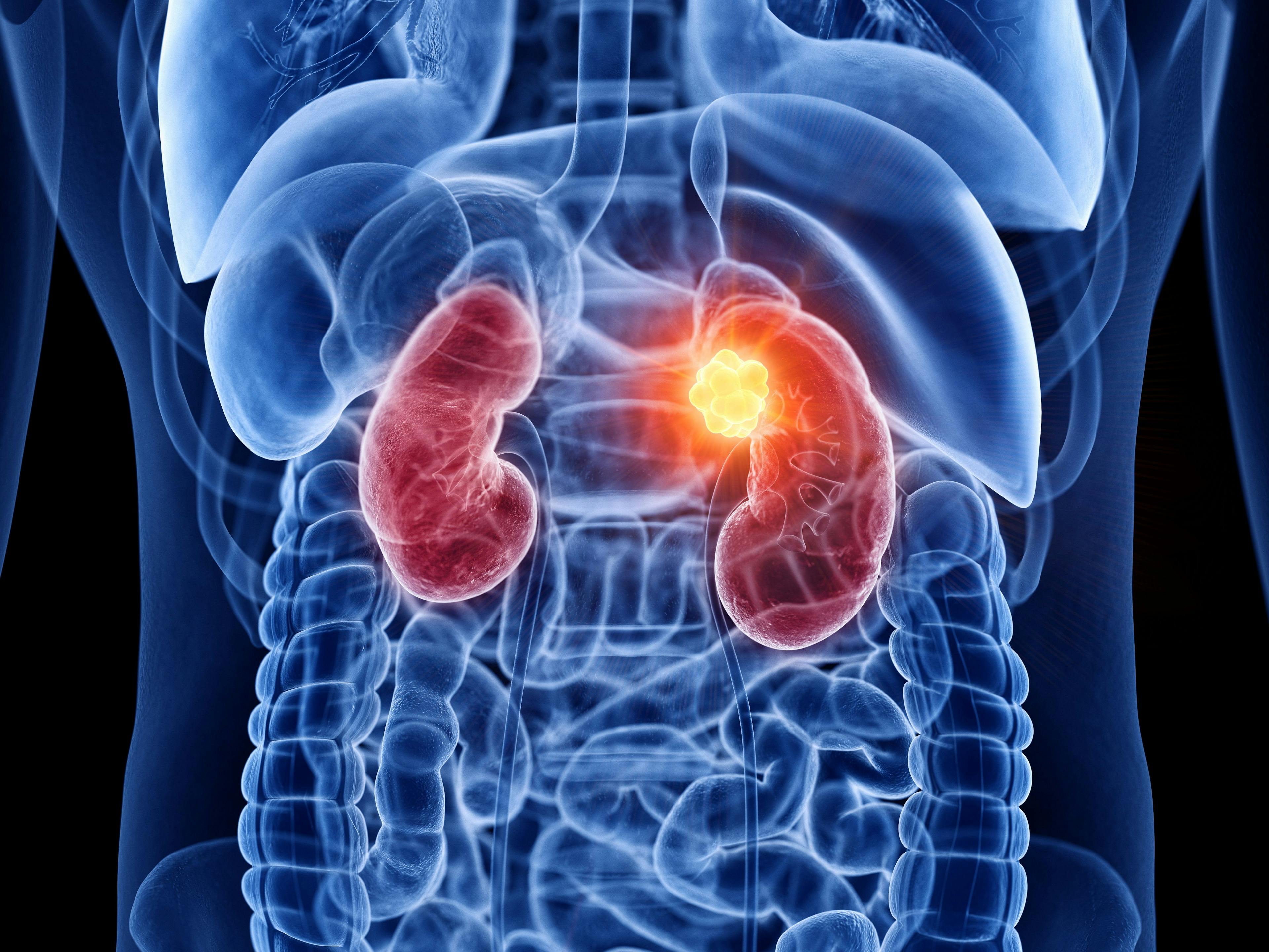 3D rendered medically accurate illustration of kidney cancer: © Sebastian Kaulitzki via Adobe Stock