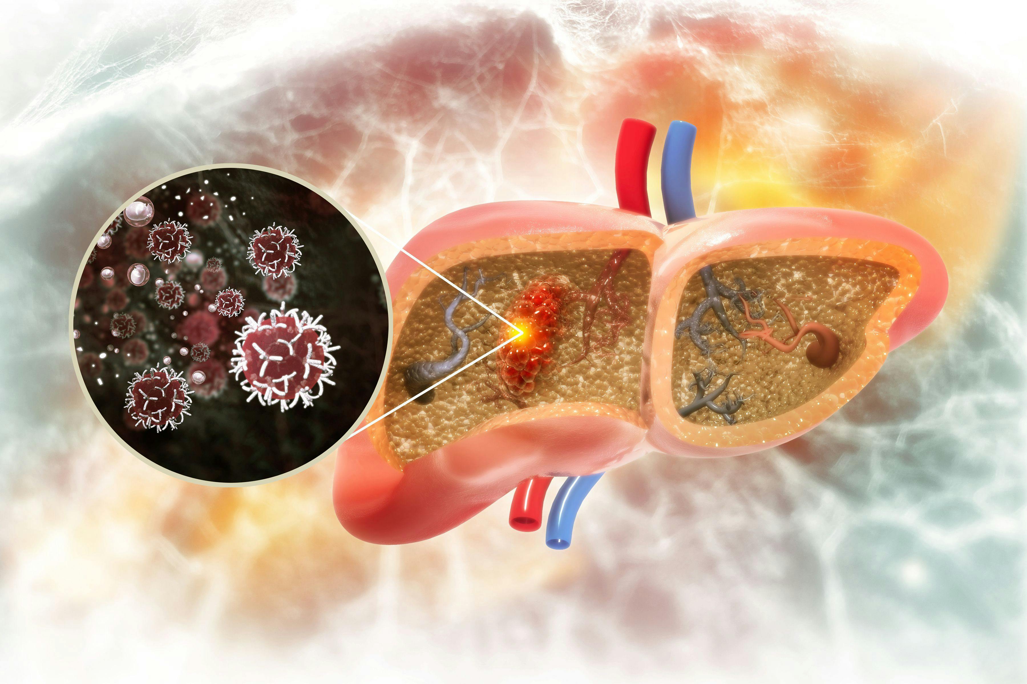 Liver cancer, 3D illustration: © vitanovski - stock.adobe.com