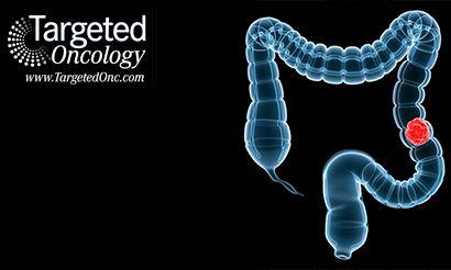 Metastatic Colorectal Cancer Target May Prove Promising for Subset of Patients