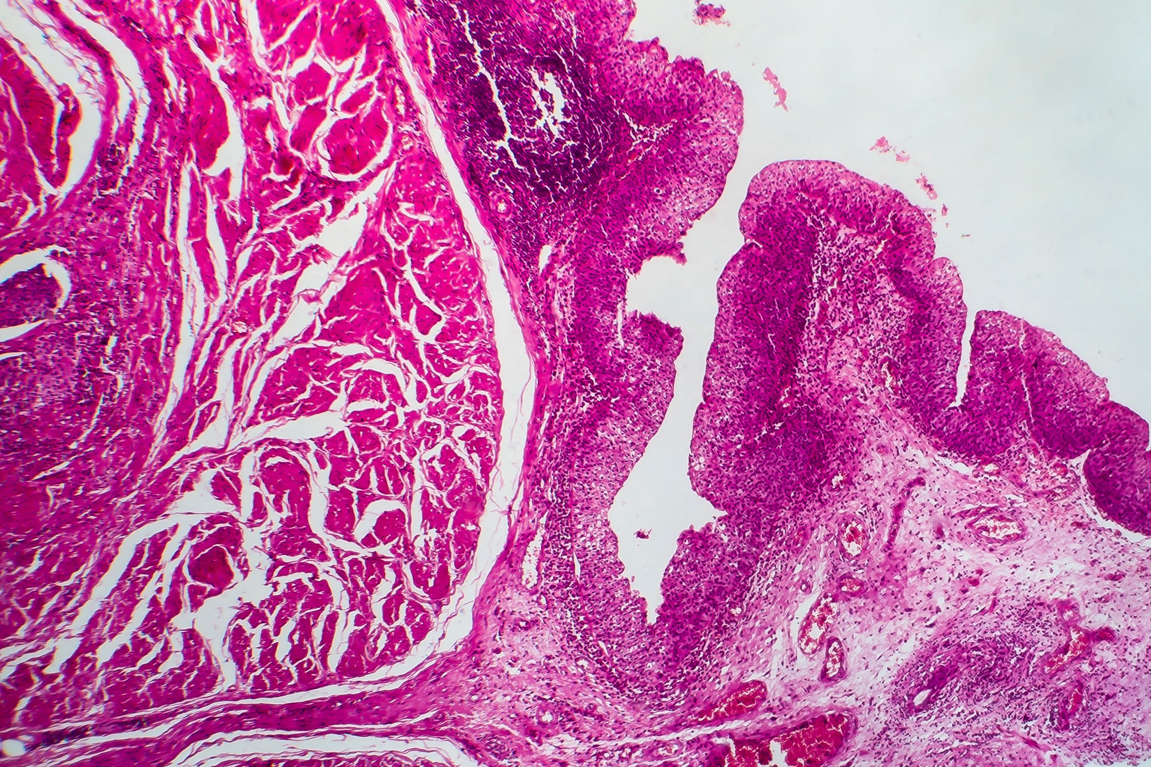 Bladder cancer, light micrograph, photo under microscope: ©Dr_Microbe - stock.adobe.com