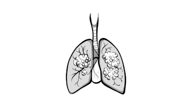 Amivantamab/Lazertinib Shows Potential in Atypical EGFR-Mutant Lung Cancer