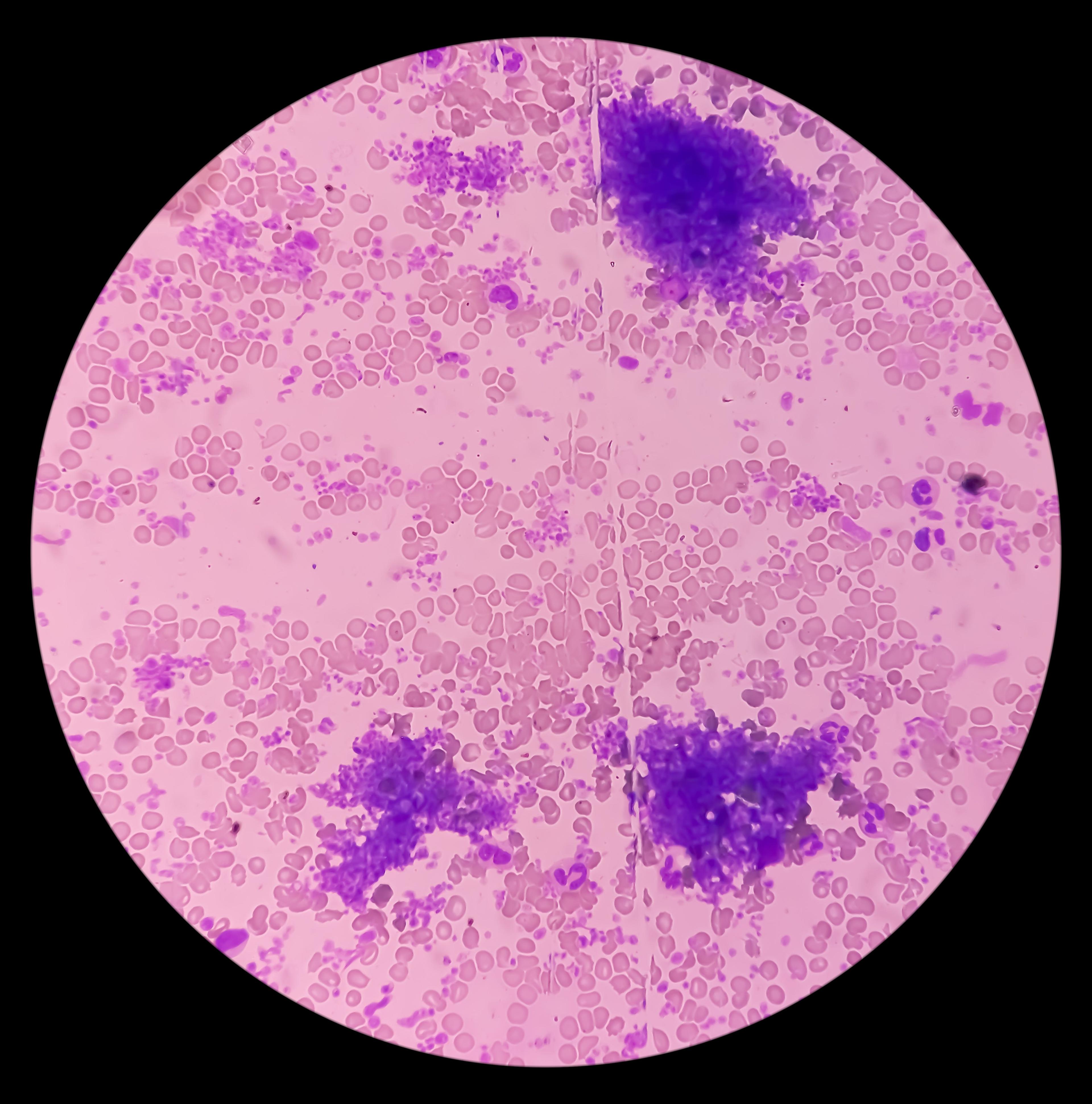 Essential thrombocytosis blood smear - ©MdBabul - stock.adobe.com