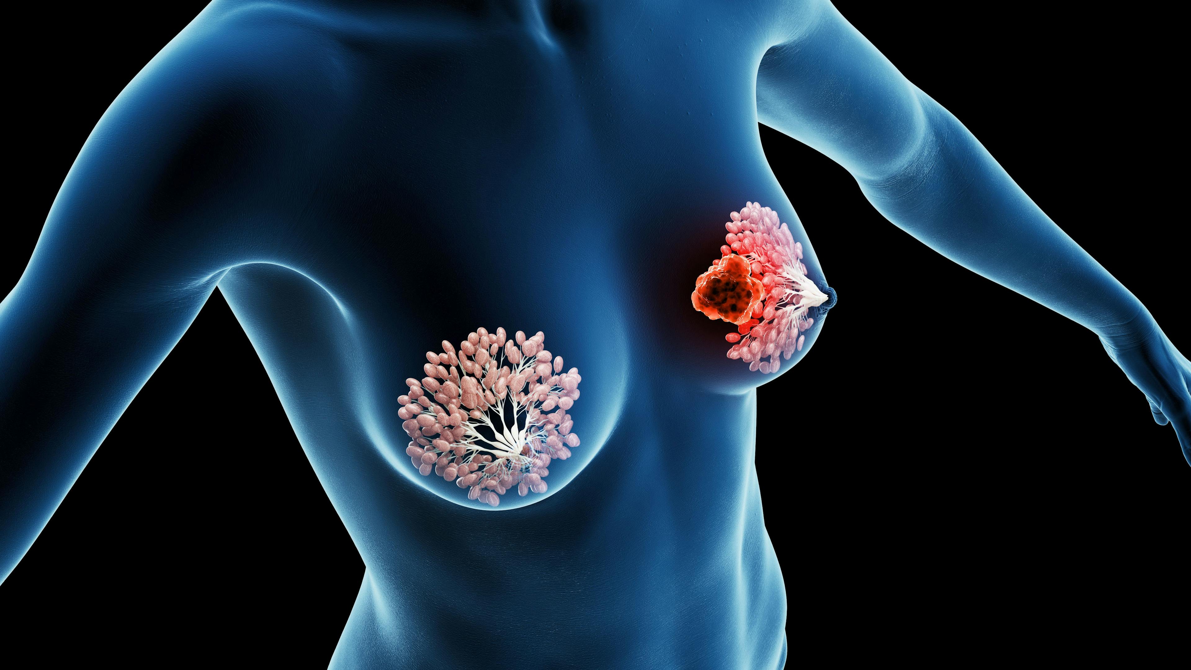 3d rendered medical illustration of breast cancer: © Sebastian Kaulitzki - stock.adobe.com