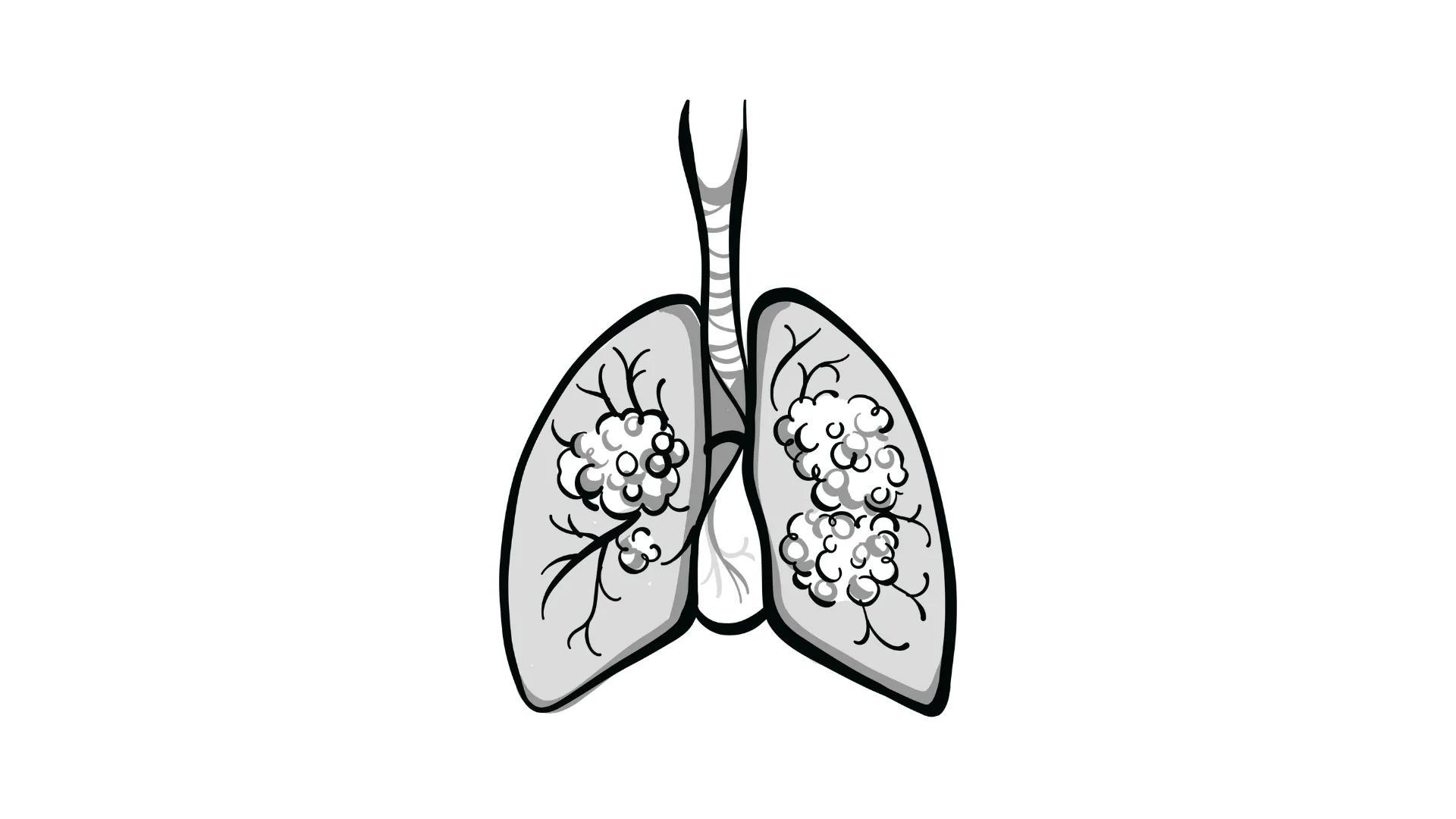 Firmonertinib Demonstrates Response in NSCLC With EGFR PACC Mutation