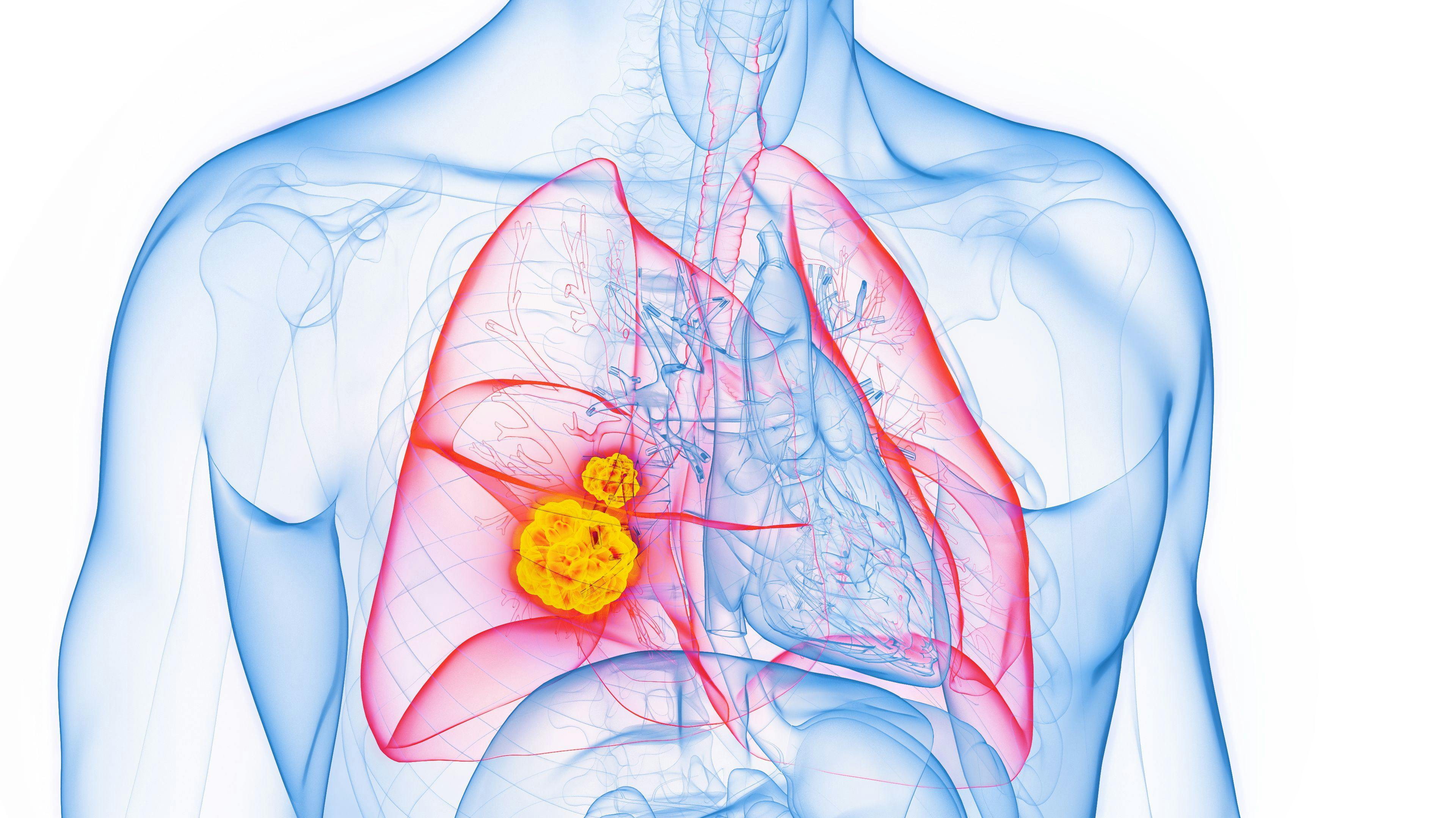 3D rendered medical illustration of male anatomy with lung cancer:© Sebastian Kaulitzki- stock.adobe.com